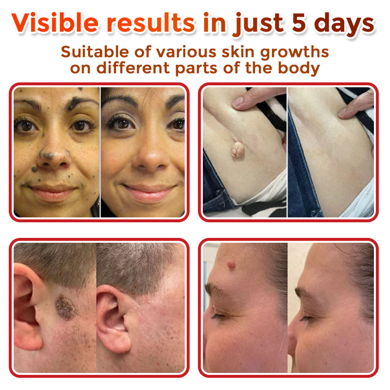 👩⚕️👩⚕️ GFOUK® MicroNeedle Botanic Skin Tag Removal Patch Aligned with NHS Skincare Guidance