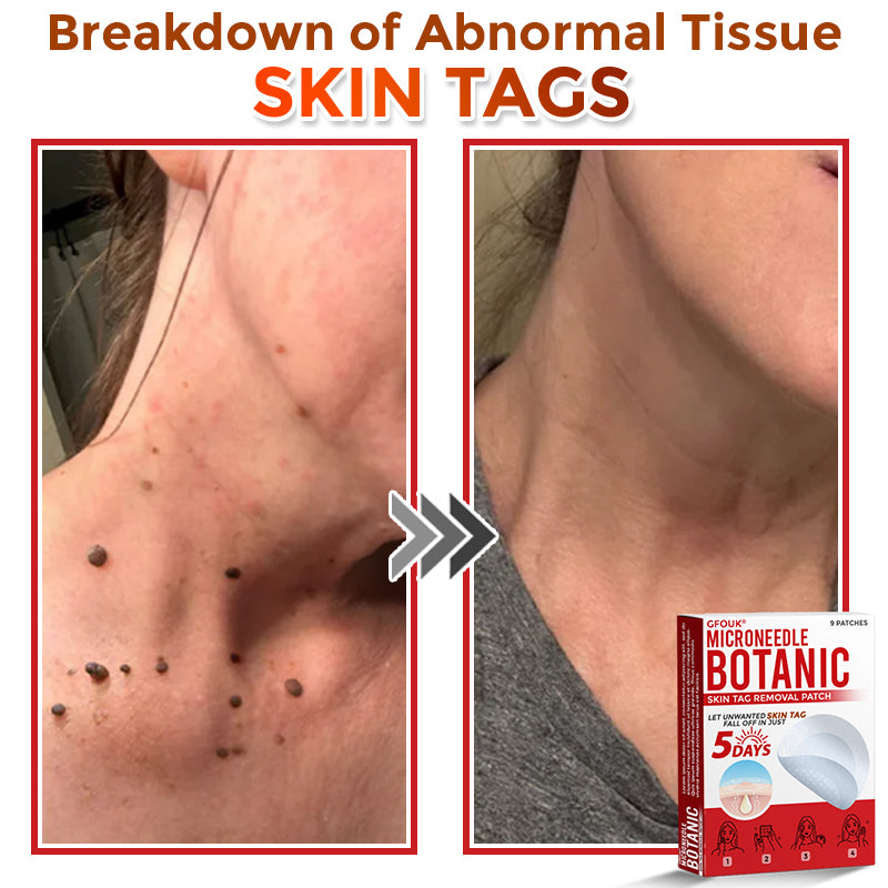 GFOUK® MicroNeedle Botanic Skin Tag Removal Patch Aligned with NHS Skincare Guidance