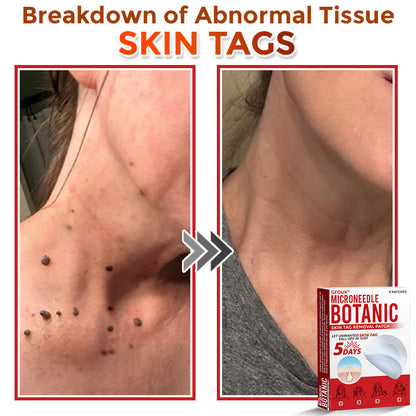 GFOUK® MicroNeedle Botanic Skin Tag Removal Patch Aligned with NHS Skincare Guidance