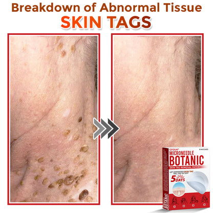 GFOUK® MicroNeedle Botanic Skin Tag Removal Patch Aligned with NHS Skincare Guidance